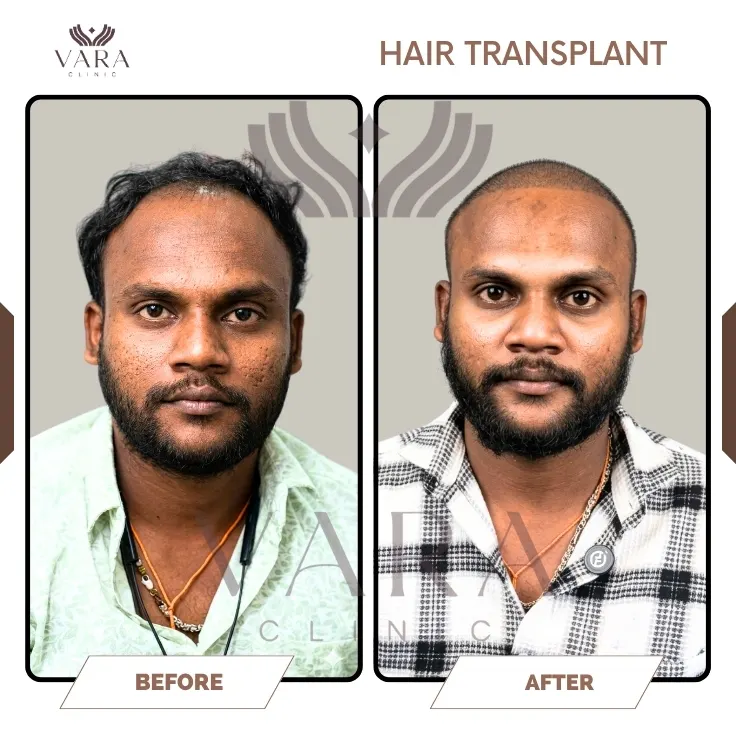 Hair Transplantation Before Result
