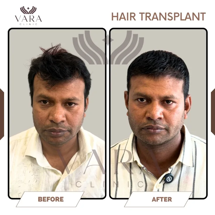 Hair Transplantation Before Result