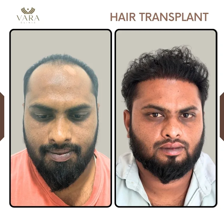 Hair Transplantation Before Result
