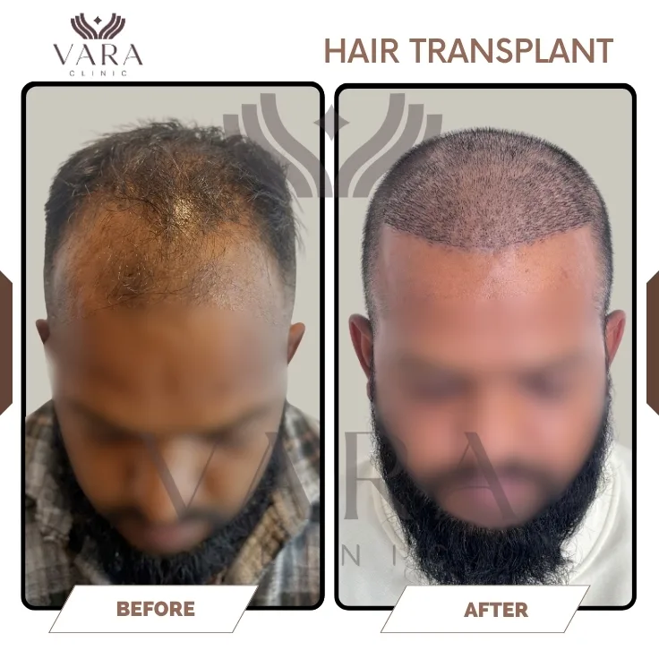 Hair Transplantation Before Result