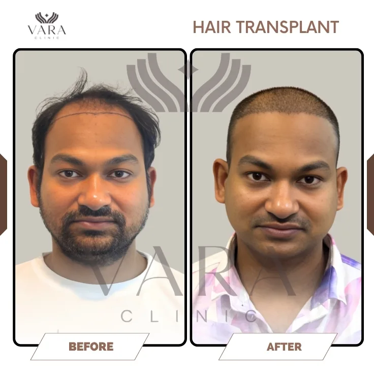 Hair Transplantation Before Result
