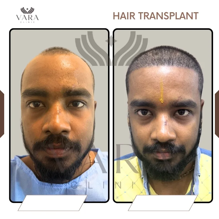 Hair Transplantation Before Result