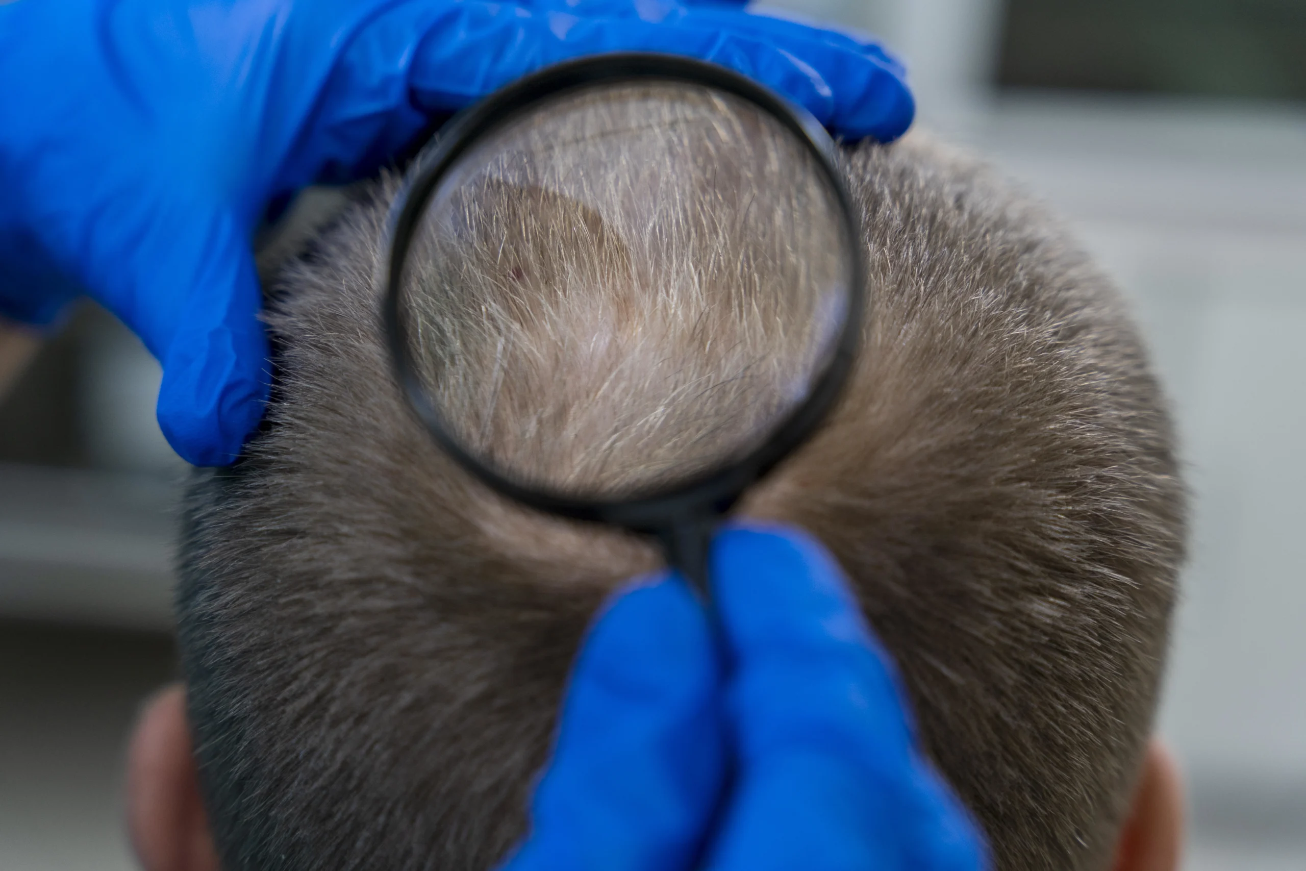 baldness treatment in bangalore