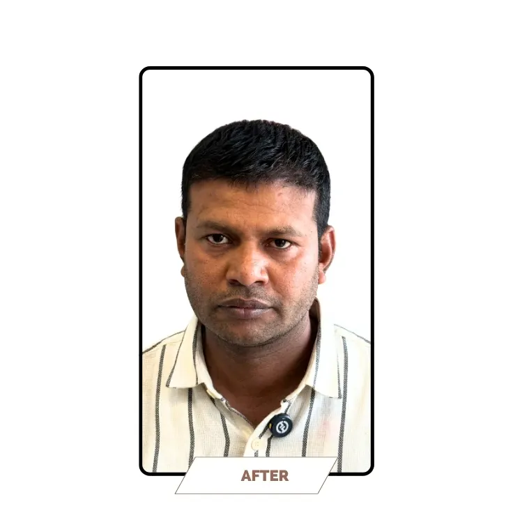 Hair Transplantation After Result