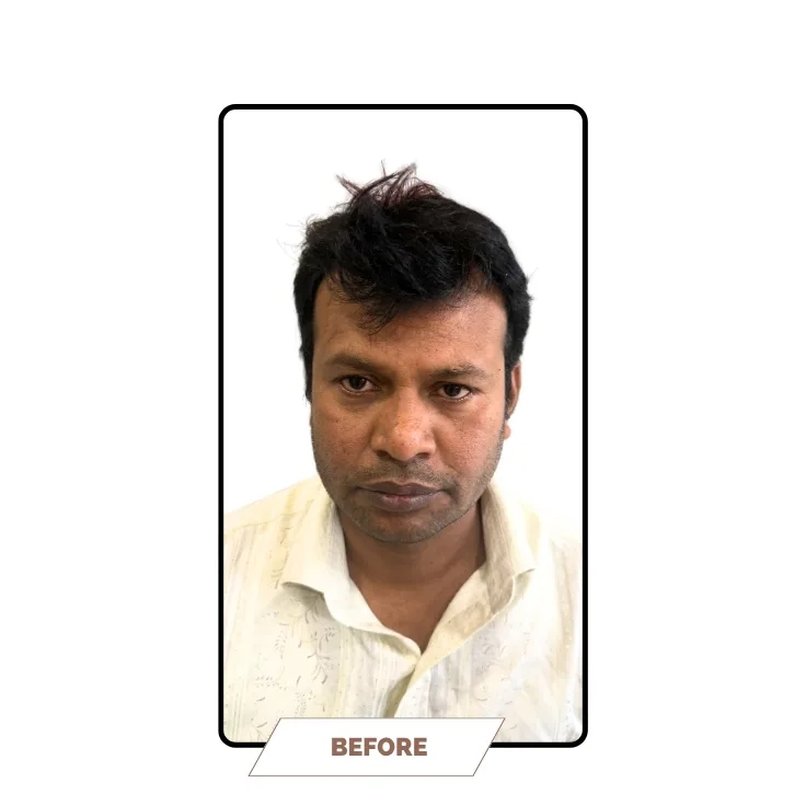 Hair Transplantation Before Result