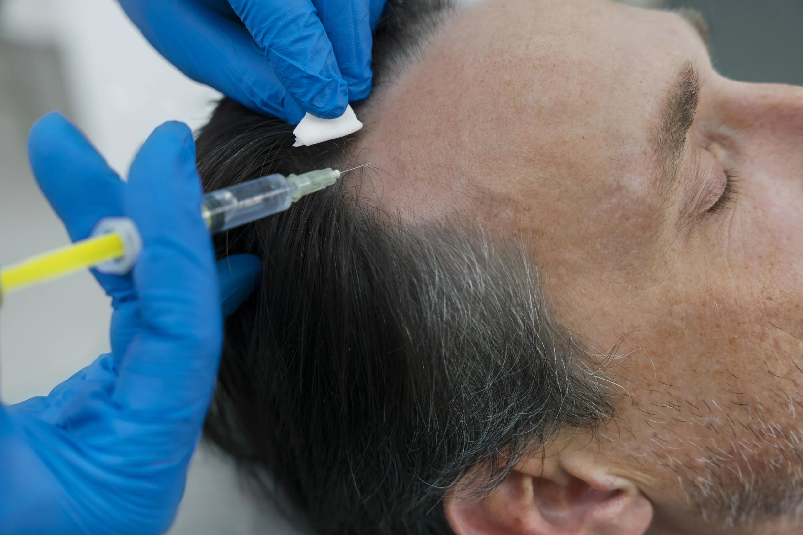 prp hair treatment in bangalore