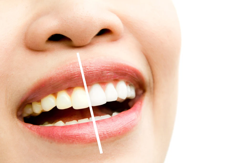 Best Dental Care in Bangalore