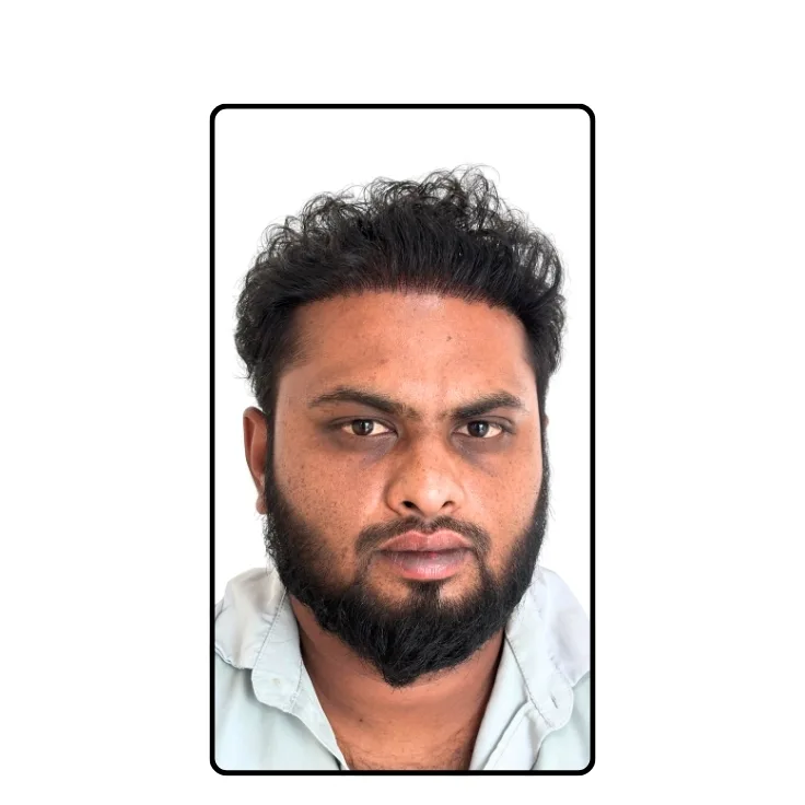Hair Transplantation After Result