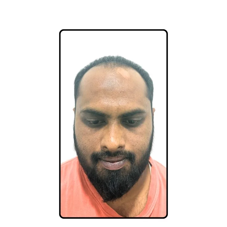 Hair Transplantation Before Result